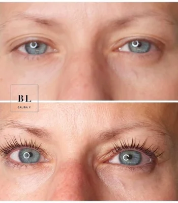 InLei -taivutus???? #blgalinav #bluelagoonbeauty #inlei #inleilashfiller