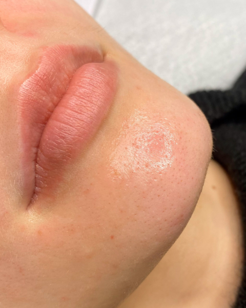 HydraFacial-kasvohoito Blue Lagoon Beauty