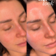 Sara Bee HydraFacial Signature -kasvohoidossa.