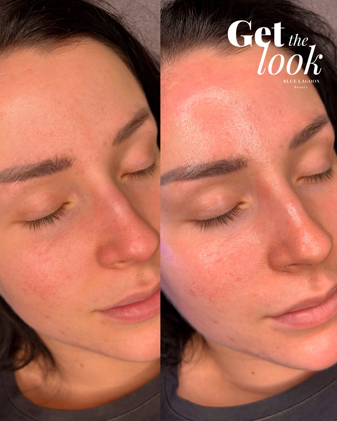 Get the look - HydraFacial-kasvohoito Sara Beelle!