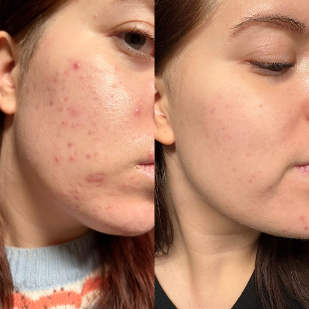 Tämän kuvan nimi on dermapen-5x-vilmat-kallio