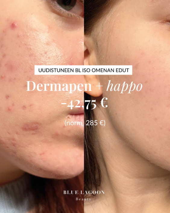 dermapenetu-bluelagoon