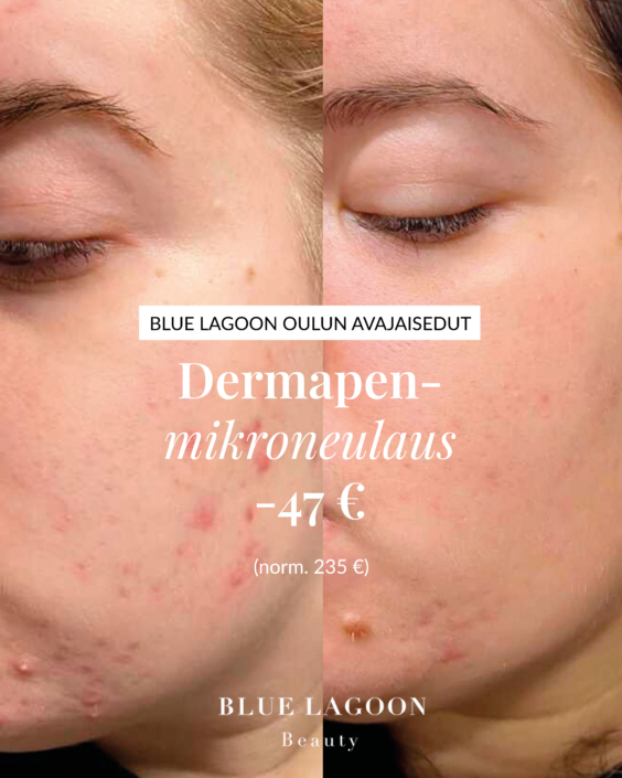 dermapentarjous-oulu
