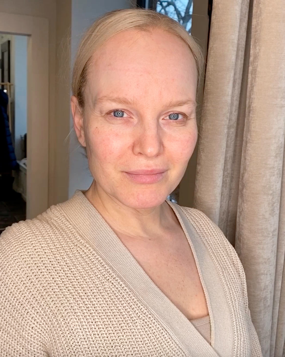 Tämän kuvan nimi on dermapen-mikroneulaus